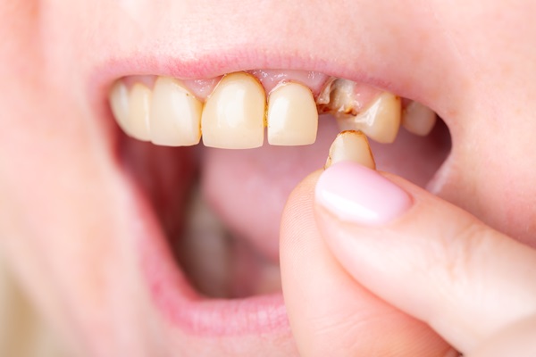 Can A Broken Tooth Be Saved?