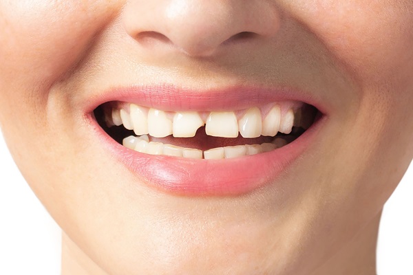 What To Do When You Have A Chipped Tooth