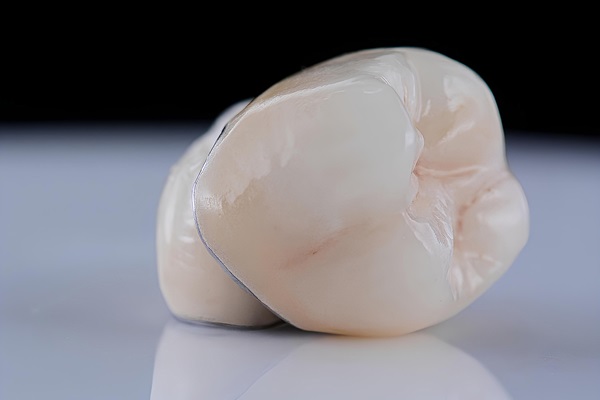 Material Options For Dental Crowns