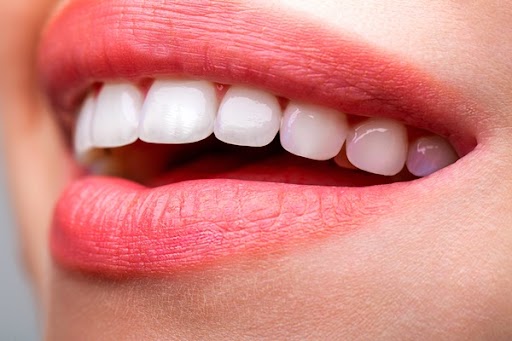 Guidelines To Know If You Are A Candidate For Dental Veneers